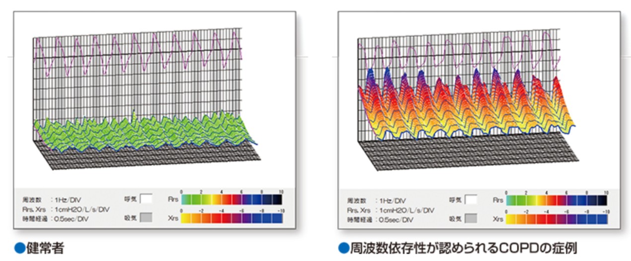 健常者と周波数依存性が認められるCOPDの症例の波形グラフ