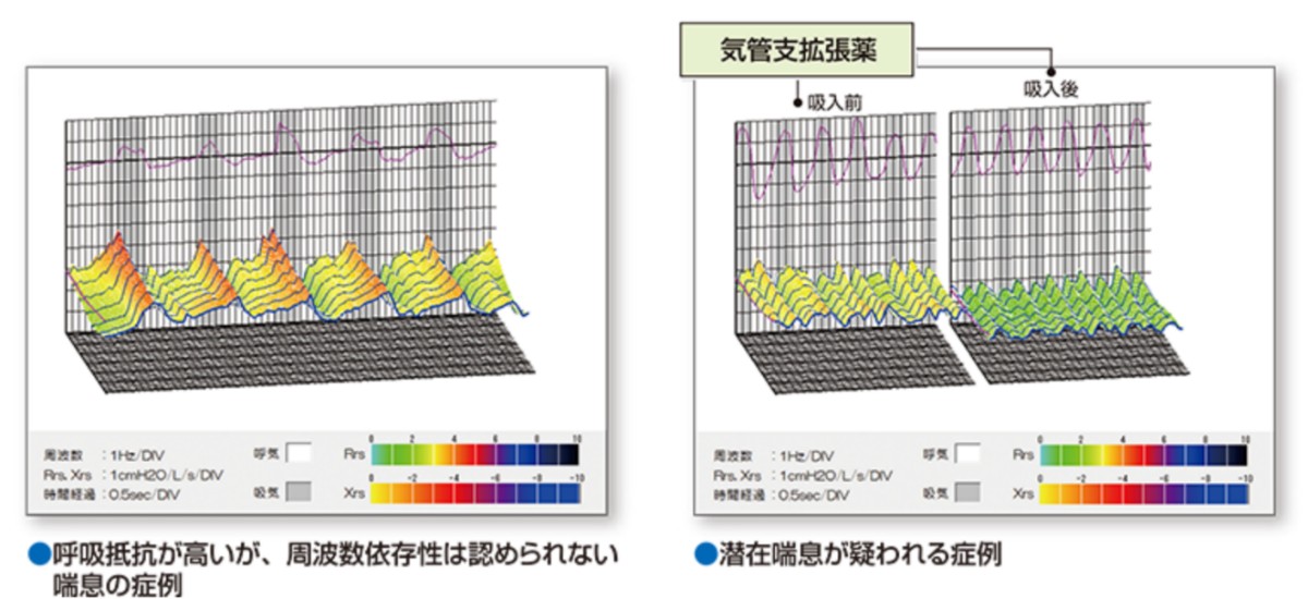 潜在喘息が疑われる症例と呼吸抵抗が高いが周波数依存性は認められない喘息の症例の波形グラフ