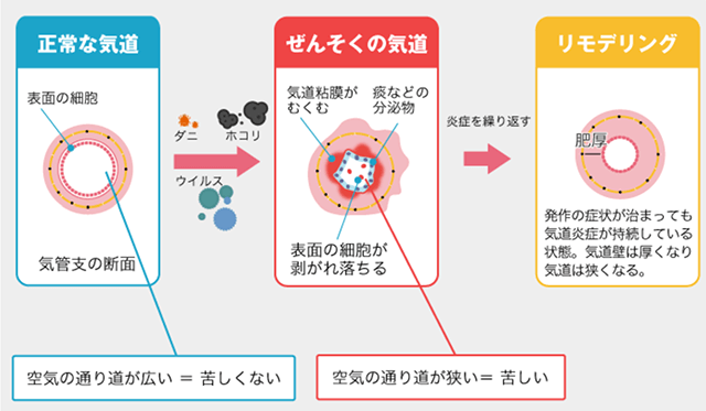 喘息患者さんの気道炎症